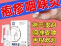 儿童疱疹性咽峡炎用药有哪些注意事项？如何安全有效缓解症状？
