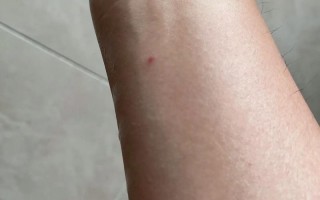 新生儿脸上有小红点图片是湿疹还是其他皮肤问题？