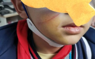 新生儿脸被指甲划出血，新手爸妈该如何正确处理伤口与预防？