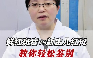 新生儿斑痣和鲜红斑痣有何不同？
