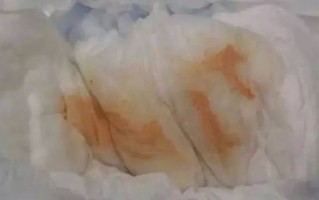 新生儿下面白色分泌物正常吗？