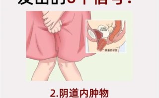 孕期遭遇子宫下垂，产后究竟能否自行恢复？