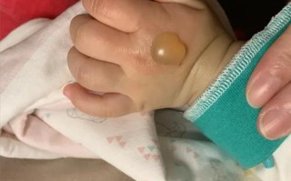 儿童被开水烫伤的图片为何能传播？家长该如何避免这种悲剧？