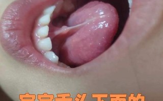 新生儿舌头下的筋短会影响吃奶和说话吗？需要手术吗？