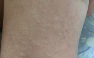 儿童过敏身上起红疙瘩，是哪些因素导致的？如何有效缓解？