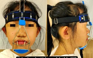 儿童地包天牙套矫正器真的能改善脸型吗？最佳佩戴年龄是几岁？