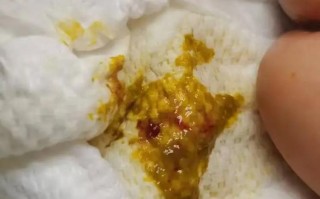 孕期严重便秘大便出血