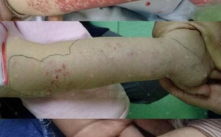 儿童溶血症有哪些典型症状？家长该如何早期识别与应对？