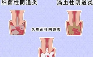 孕期外阴肿胀是什么原因造成的？需要担心吗？