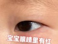 新生儿眼角鲜红斑痣图能看出严重程度吗？需要治疗吗？