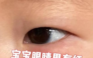 新生儿眼角鲜红斑痣图能看出严重程度吗？需要治疗吗？