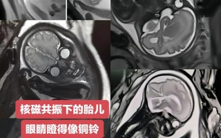 新生儿核磁共振检查有影响吗？