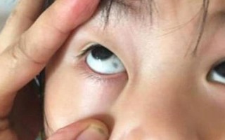 儿童眼睛里的黑斑是先天性的吗？需要警惕哪些眼部疾病？