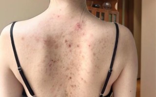 怀孕背后痘痘频发，是激素波动还是身体在报警？