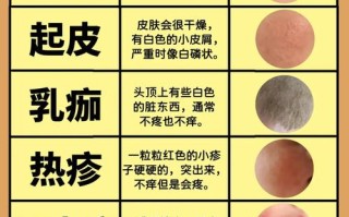 新生儿湿疹不严重需要干预吗？日常护理要注意哪些细节才能缓解？