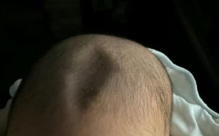 不小心打到新生儿囟门后，家长该如何判断和处理？