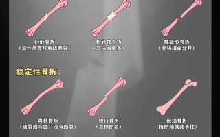 儿童最常见的骨折类型是什么？不同年龄段儿童骨折类型有何差异？