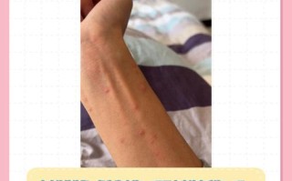 儿童水痘传染期具体有多长？不同阶段传染性有何差异？