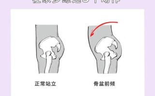 儿童纠正骨盆前倾最佳方法
