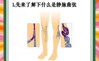 孕期如何有效预防静脉曲张？有哪些科学方法能缓解腿部不适？