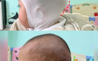 新生儿头骨突出是正常现象吗？需要担心什么问题？