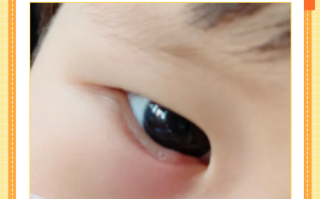 儿童眼睛下面突然肿了，是过敏还是肾病信号？家长该怎么处理？