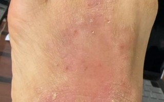 孕期脚上起小水泡湿疹