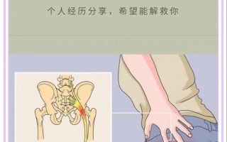 孕期左侧屁股痛是压迫神经还是缺钙？怎么缓解才安全？