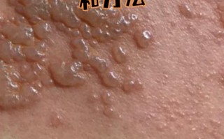 儿童疱疹病毒感染图片有哪些典型症状？如何通过图片辨别不同类型感染？