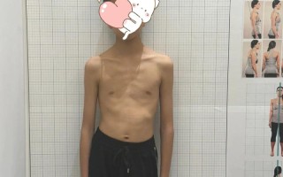 12岁儿童佝偻病驼背，是发育问题还是疾病信号？如何科学干预与矫正？