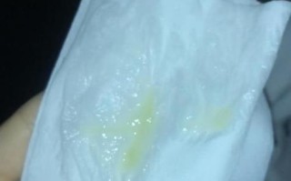 孕期水样白带干后发黄是感染信号吗？需警惕哪些异常情况？