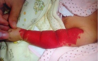 儿童手臂红色疙瘩是过敏、湿疹还是其他皮肤问题？需如何护理与治疗？