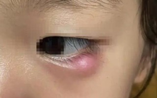 孕期眼睛下面长小疙瘩