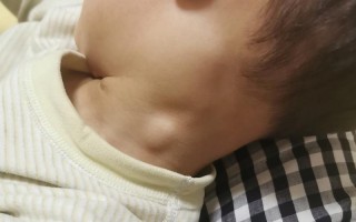 儿童颌下腺淋巴结肿大是什么原因引起的？需要治疗吗？