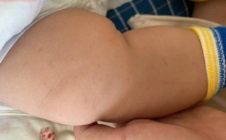 新生儿身上很多出血点