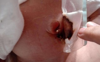 新生儿肚脐眼红肿图片正常吗？需要就医处理吗？