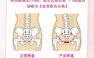 孕期耻骨分离怎么检查？需要做哪些检查项目？