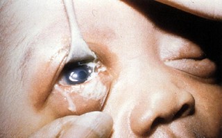 新生儿感染沙眼衣原体有何症状？如何治疗与预防？