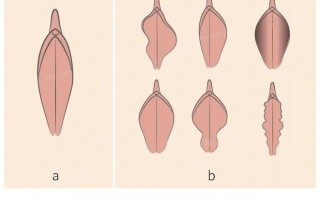 孕期阴唇长小疙瘩是什么原因？需要担心吗？附图片对比解析