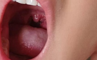 儿童嗓子红和不红图片对比，如何通过症状区分普通感冒与链球菌感染？