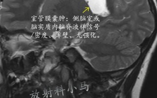 新生儿右侧室管膜囊肿需要治疗吗？会影响发育吗？