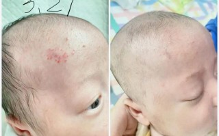 新生儿鼻孔血管瘤图片长什么样？需要警惕哪些特征？