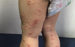 儿童出疹子症状图片怎么辨别？治疗要注意什么？