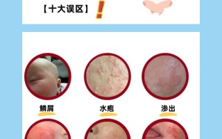 新生儿脸上湿疹反复发作，究竟是什么原因在作祟？