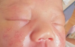 新生儿痤疮到底能不能用茶油治疗？茶油涂抹对宝宝皮肤安全吗？