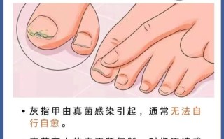 怀孕期间灰指甲怎么办