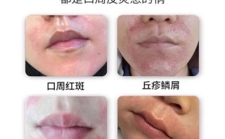 儿童下巴湿疹擦什么药