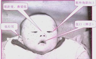 新生儿18三体综合征