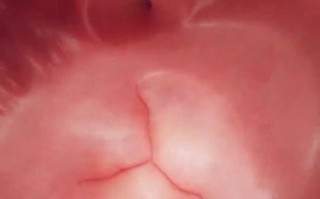 新生儿三尖瓣关闭不全是什么原因引起的？需要治疗吗？