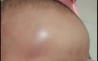新生儿脑袋被撞了一下